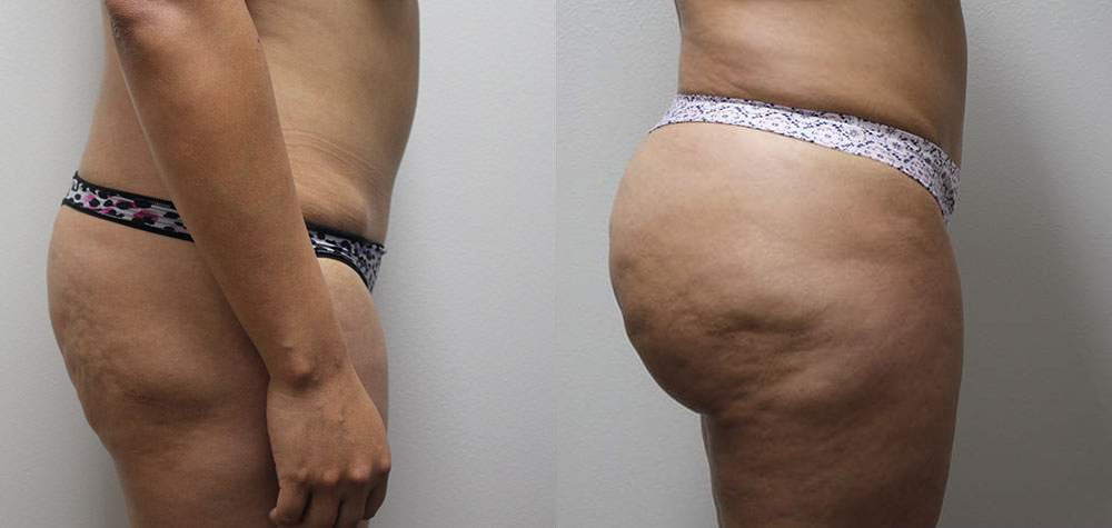 buttocks brazilian butt lift before and after photos by kryger institute of plastic surgery in thousand oaks ca buttocks brazilian butt lift before and after photos by kryger institute of plastic surgery in thousand oaks ca