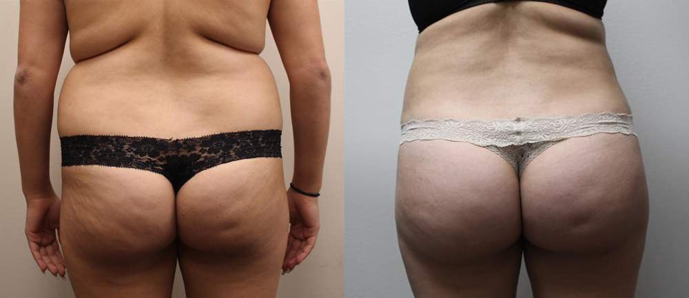 buttocks brazilian butt lift before and after photos by kryger institute of plastic surgery in thousand oaks ca buttocks brazilian butt lift before and after photos by kryger institute of plastic surgery in thousand oaks ca