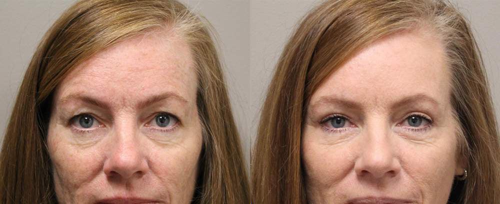 blepharoplasty before and after photos by kryger institute of plastic surgery in thousand oaks ca blepharoplasty before and after photos by kryger institute of plastic surgery in thousand oaks ca