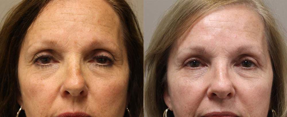 blepharoplasty before and after photos by kryger institute of plastic surgery in thousand oaks ca blepharoplasty before and after photos by kryger institute of plastic surgery in thousand oaks ca