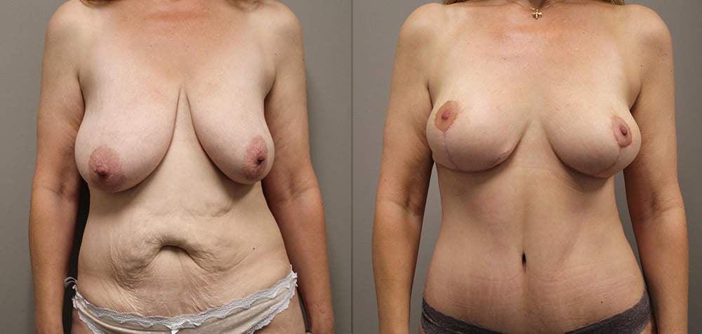 tummy tuck before and after photos by kryger institute of plastic surgery in thousand oaks ca tummy tuck before and after photos by kryger institute of plastic surgery in thousand oaks ca