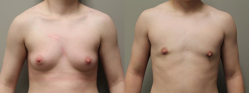 female to male transition before and after photos by kryger institute of plastic surgery in thousand oaks ca female to male transition before and after photos by kryger institute of plastic surgery in thousand oaks ca