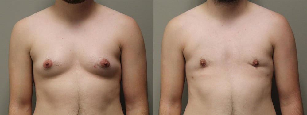 female to male transition before and after photos by kryger institute of plastic surgery in thousand oaks ca female to male transition before and after photos by kryger institute of plastic surgery in thousand oaks ca