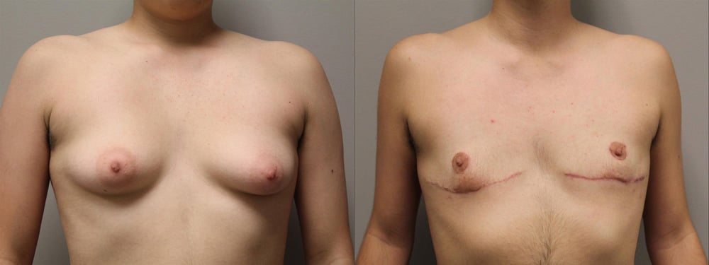 female to male transition before and after photos by kryger institute of plastic surgery in thousand oaks ca female to male transition before and after photos by kryger institute of plastic surgery in thousand oaks ca