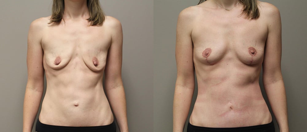 fat grafting breast before and after photos by kryger institute of plastic surgery in thousand oaks ca fat grafting breast before and after photos by kryger institute of plastic surgery in thousand oaks ca