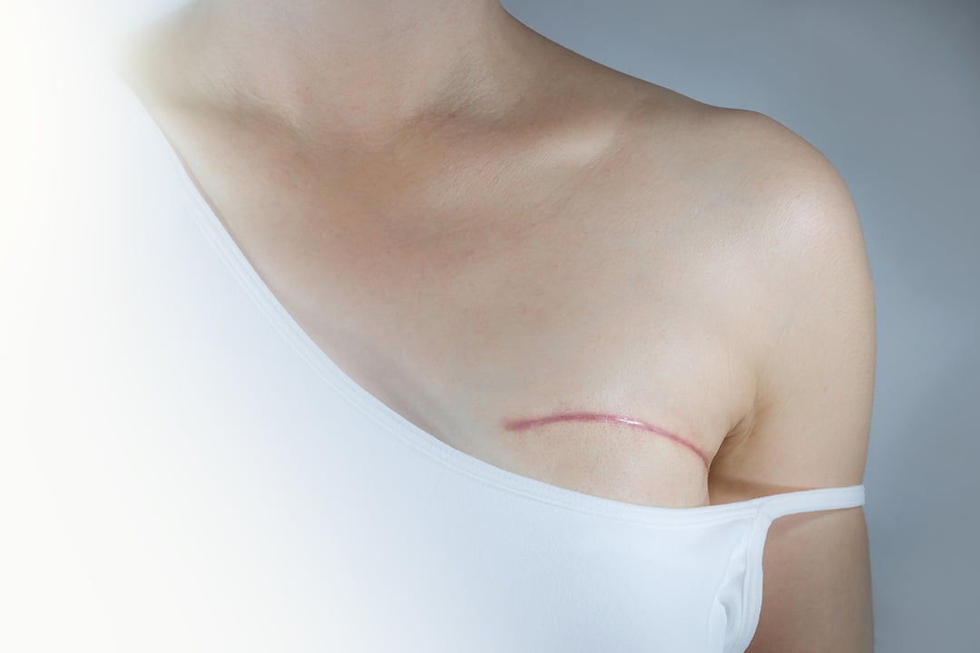 What Every Woman Should Know About Preventive Mastectomy