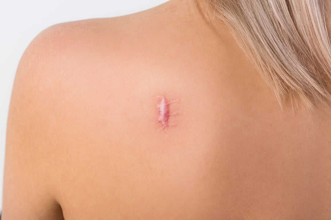 Top 3 Tips for Preventing, and Improving the Appearance of Your Scars.