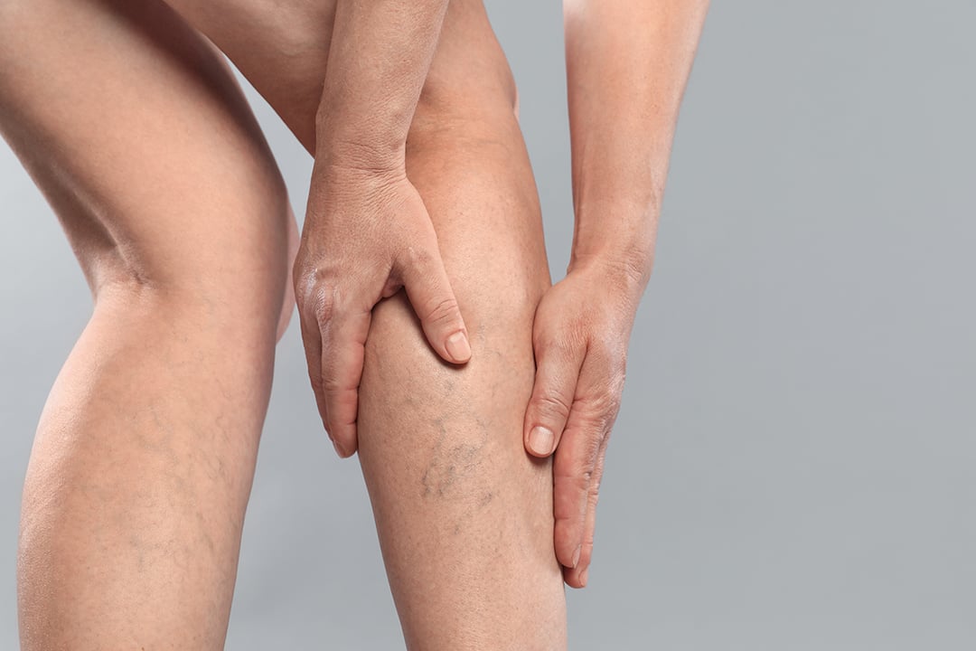 Laser Vein Treatment in Thousand Oaks