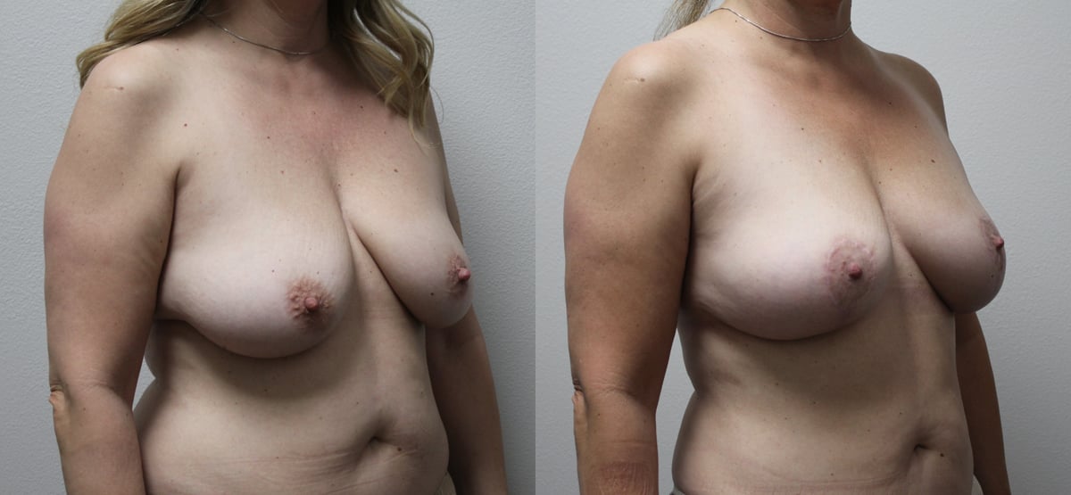fat grafting breast before and after photos by kryger institute of plastic surgery in thousand oaks ca fat grafting breast before and after photos by kryger institute of plastic surgery in thousand oaks ca