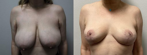 breast reduction lift before and after photos by kryger institute of plastic surgery in thousand oaks ca