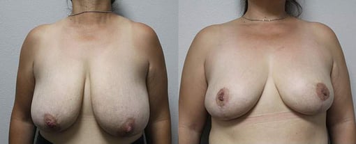 breast reduction lift before and after photos by kryger institute of plastic surgery in thousand oaks ca