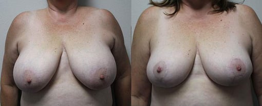 breast reduction lift before and after photos by kryger institute of plastic surgery in thousand oaks ca