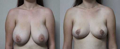 breast reduction lift before and after photos by kryger institute of plastic surgery in thousand oaks ca