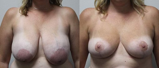 breast reduction lift before and after photos by kryger institute of plastic surgery in thousand oaks ca