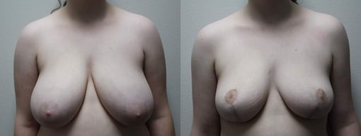 breast reduction lift before and after photos by kryger institute of plastic surgery in thousand oaks ca