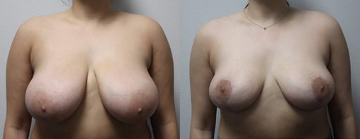 breast reduction lift before and after photos by kryger institute of plastic surgery in thousand oaks ca