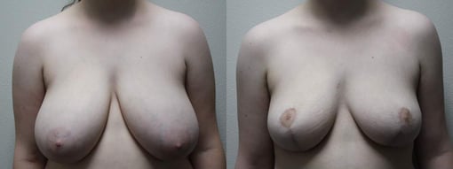 breast reduction lift before and after photos by kryger institute of plastic surgery in thousand oaks ca