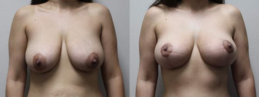 breast reduction lift before and after photos by kryger institute of plastic surgery in thousand oaks ca