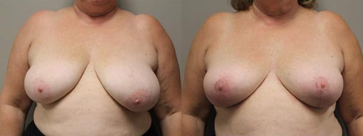 breast reduction lift before and after photos by kryger institute of plastic surgery in thousand oaks ca
