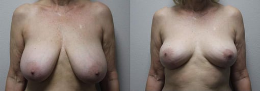 breast reduction lift before and after photos by kryger institute of plastic surgery in thousand oaks ca