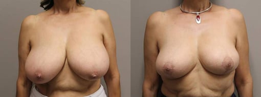 breast reduction lift before and after photos by kryger institute of plastic surgery in thousand oaks ca