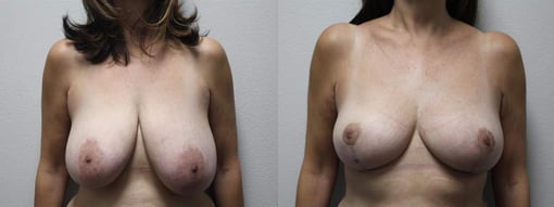 breast reduction lift before and after photos by kryger institute of plastic surgery in thousand oaks ca
