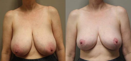 breast reduction lift before and after photos by kryger institute of plastic surgery in thousand oaks ca