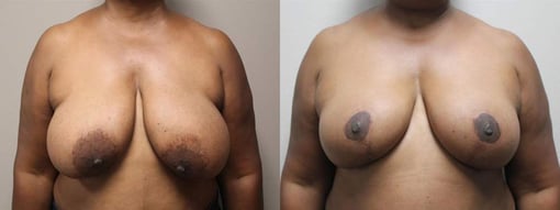 breast reduction lift before and after photos by kryger institute of plastic surgery in thousand oaks ca