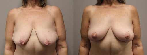 breast reduction lift before and after photos by kryger institute of plastic surgery in thousand oaks ca