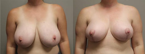 breast reduction lift before and after photos by kryger institute of plastic surgery in thousand oaks ca