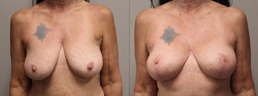 breast reduction lift before and after photos by kryger institute of plastic surgery in thousand oaks ca