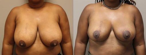 breast reduction lift before and after photos by kryger institute of plastic surgery in thousand oaks ca