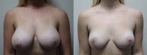 breast reduction lift before and after photos by kryger institute of plastic surgery in thousand oaks ca