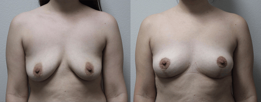 breast reduction lift before and after photos by kryger institute of plastic surgery in thousand oaks ca