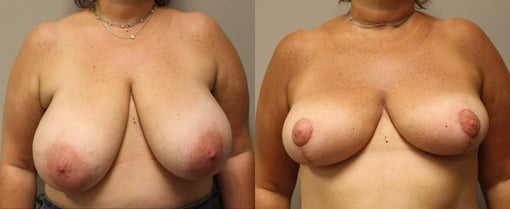 breast reduction lift before and after photos by kryger institute of plastic surgery in thousand oaks ca