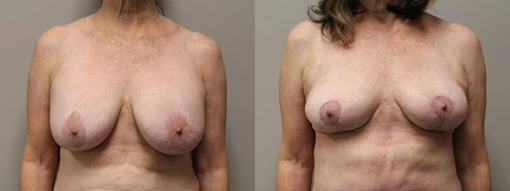 breast reduction lift before and after photos by kryger institute of plastic surgery in thousand oaks ca