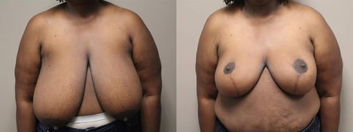 breast reduction lift before and after photos by kryger institute of plastic surgery in thousand oaks ca