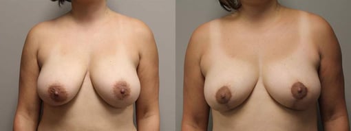 breast reduction lift before and after photos by kryger institute of plastic surgery in thousand oaks ca