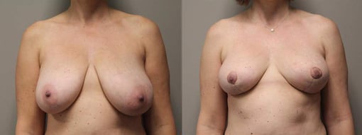 breast reduction lift before and after photos by kryger institute of plastic surgery in thousand oaks ca
