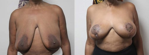 breast reduction lift before and after photos by kryger institute of plastic surgery in thousand oaks ca