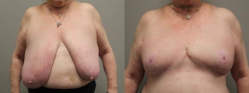 breast reduction lift before and after photos by kryger institute of plastic surgery in thousand oaks ca