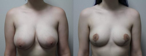 breast reduction lift before and after photos by kryger institute of plastic surgery in thousand oaks ca