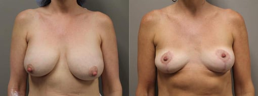 breast reduction lift before and after photos by kryger institute of plastic surgery in thousand oaks ca