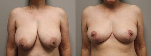 breast reduction lift before and after photos by kryger institute of plastic surgery in thousand oaks ca