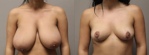 breast reduction lift before and after photos by kryger institute of plastic surgery in thousand oaks ca
