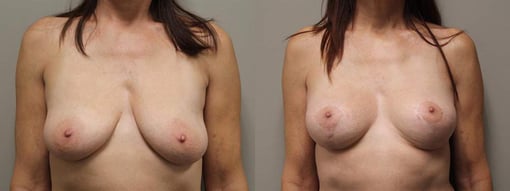 breast reduction lift before and after photos by kryger institute of plastic surgery in thousand oaks ca