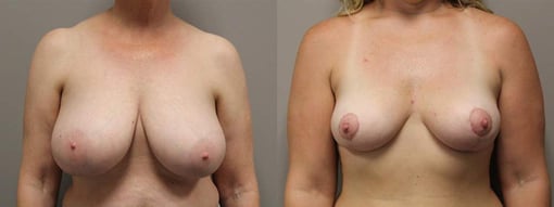 breast reduction lift before and after photos by kryger institute of plastic surgery in thousand oaks ca