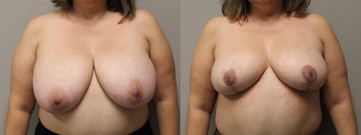breast reduction lift before and after photos by kryger institute of plastic surgery in thousand oaks ca