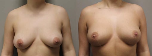 breast reduction lift before and after photos by kryger institute of plastic surgery in thousand oaks ca