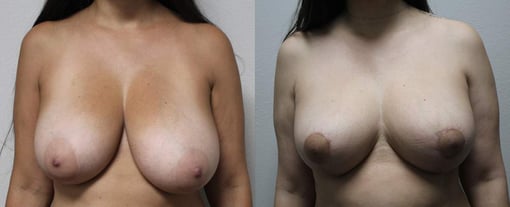 breast reduction lift before and after photos by kryger institute of plastic surgery in thousand oaks ca